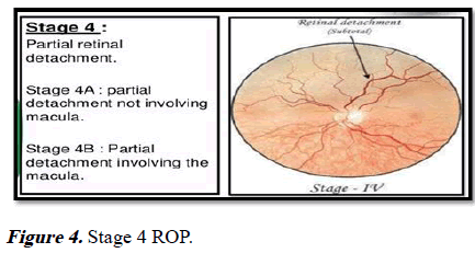 aajcp-Stage 4